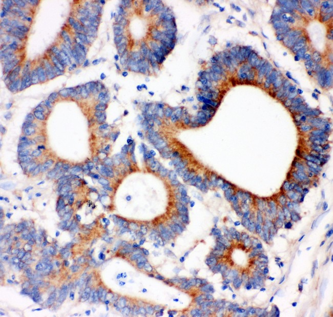 IRS1 Antibody - IRS1 antibody IHC-paraffin: Human Intestinal Cancer Tissue.