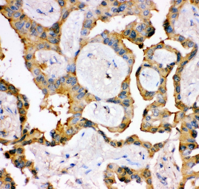 IRS1 Antibody - IRS1 antibody IHC-paraffin: Human Lung Cancer Tissue.