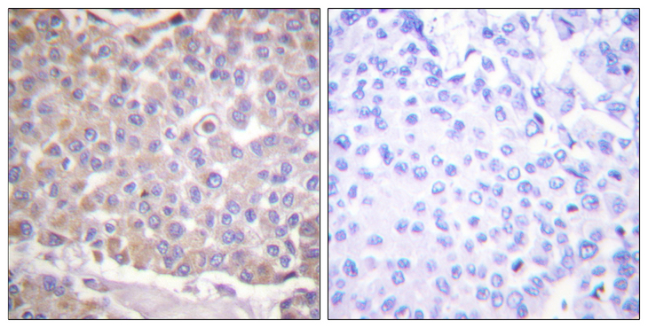IRS1 Antibody - Immunohistochemistry analysis of paraffin-embedded human breast carcinoma tissue, using IRS-1 Antibody. The picture on the right is blocked with the synthesized peptide.
