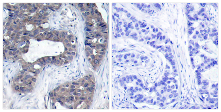 IRS1 Antibody - Immunohistochemistry analysis of paraffin-embedded human breast carcinoma tissue, using IRS-1 Antibody. The picture on the right is blocked with the synthesized peptide.