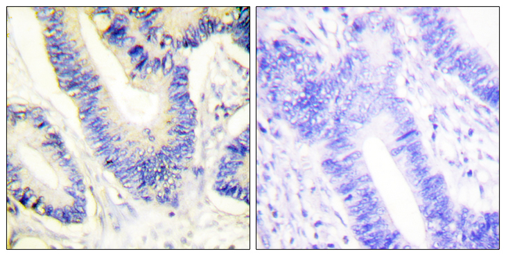 IRS1 Antibody - Immunohistochemistry analysis of paraffin-embedded human colon carcinoma tissue, using IRS-1 Antibody. The picture on the right is blocked with the synthesized peptide.