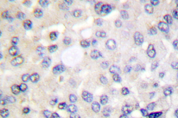 IRS1 Antibody - IHC of IRS-1 (R301) pAb in paraffin-embedded human breast carcinoma tissue.