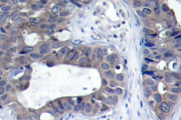 IRS1 Antibody - IHC of IRS-1 (R301) pAb in paraffin-embedded human breast carcinoma tissue.