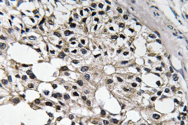 IRS1 Antibody - IHC of IRS-1 (E306) pAb in paraffin-embedded human breast carcinoma tissue.