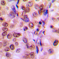 IRS1 Antibody - Immunohistochemical analysis of IRS1 staining in human breast cancer formalin fixed paraffin embedded tissue section. The section was pre-treated using heat mediated antigen retrieval with sodium citrate buffer (pH 6.0). The section was then incubated with the antibody at room temperature and detected using an HRP conjugated compact polymer system. DAB was used as the chromogen. The section was then counterstained with hematoxylin and mounted with DPX.