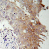 IRS1 Antibody - Immunohistochemical analysis of IRS1 staining in human prostate cancer formalin fixed paraffin embedded tissue section. The section was pre-treated using heat mediated antigen retrieval with sodium citrate buffer (pH 6.0). The section was then incubated with the antibody at room temperature and detected using an HRP polymer system. DAB was used as the chromogen. The section was then counterstained with hematoxylin and mounted with DPX.