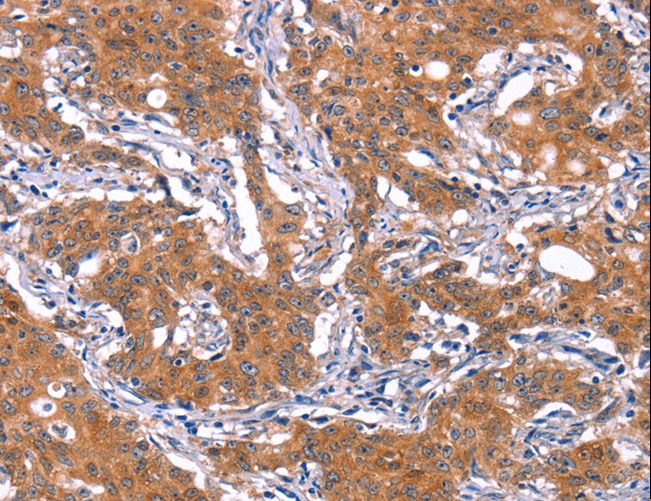 IRS1 Antibody - Immunohistochemistry of paraffin-embedded Human liver cancer using IRS1 Polyclonal Antibody at dilution of 1:30.