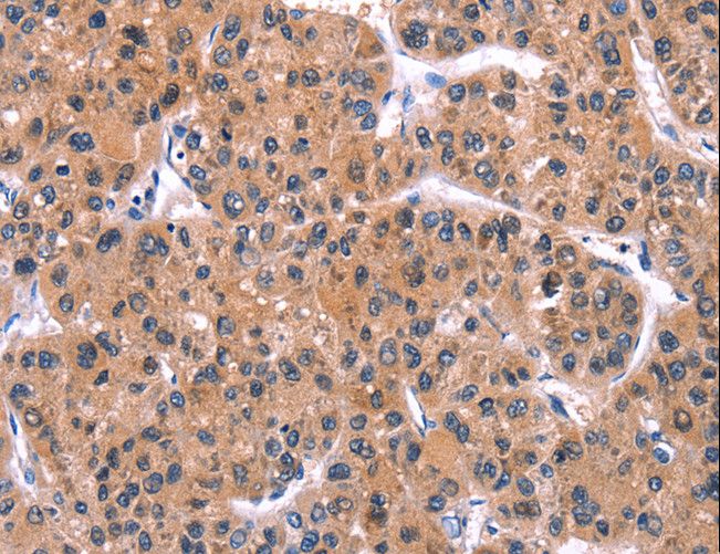 IRS1 Antibody - Immunohistochemistry of paraffin-embedded Human liver cancer using IRS1 Polyclonal Antibody at dilution of 1:30.