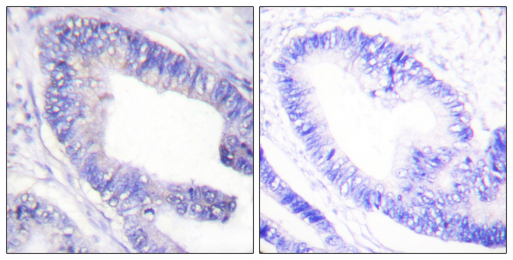 IRS1 Antibody - Immunohistochemistry analysis of paraffin-embedded human colon carcinoma, using IRS-1 (Phospho-Ser1101) Antibody. The picture on the right is blocked with the phospho peptide.
