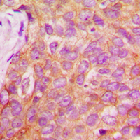 IRS1 Antibody - Immunohistochemical analysis of IRS1 (pS1101) staining in human breast cancer formalin fixed paraffin embedded tissue section. The section was pre-treated using heat mediated antigen retrieval with sodium citrate buffer (pH 6.0). The section was then incubated with the antibody at room temperature and detected using an HRP conjugated compact polymer system. DAB was used as the chromogen. The section was then counterstained with hematoxylin and mounted with DPX.