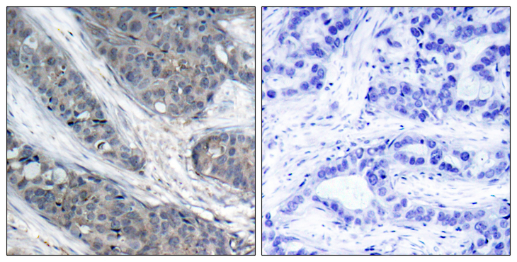 IRS1 Antibody - Immunohistochemistry analysis of paraffin-embedded human breast carcinoma, using IRS-1 (Phospho-Ser307) Antibody. The picture on the right is blocked with the phospho peptide.