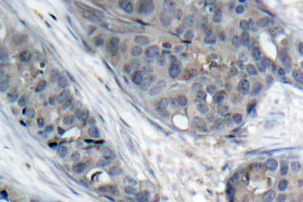 IRS1 Antibody - IHC of p-IRS-1 (S307) pAb in paraffin-embedded human breast carcinoma tissue.