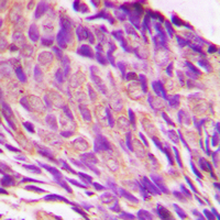 IRS1 Antibody - Immunohistochemical analysis of IRS1 (pS307) staining in human prostate cancer formalin fixed paraffin embedded tissue section. The section was pre-treated using heat mediated antigen retrieval with sodium citrate buffer (pH 6.0). The section was then incubated with the antibody at room temperature and detected using an HRP conjugated compact polymer system. DAB was used as the chromogen. The section was then counterstained with hematoxylin and mounted with DPX.