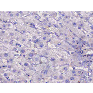 IRS1 Antibody - 1:200 staining human liver carcinoma tissues by IHC-P. The tissue was formaldehyde fixed and a heat mediated antigen retrieval step in citrate buffer was performed. The tissue was then blocked and incubated with the antibody for 1.5 hours at 22°C. An HRP conjugated goat anti-rabbit antibody was used as the secondary.