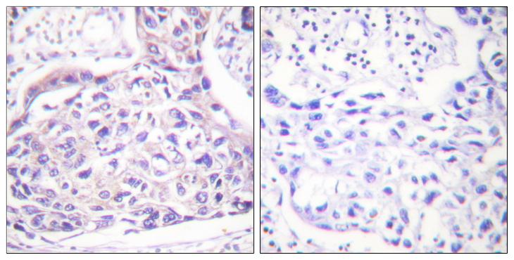 IRS1 Antibody - Immunohistochemistry analysis of paraffin-embedded human breast carcinoma, using IRS-1 (Phospho-Ser323) Antibody. The picture on the right is blocked with the phospho peptide.