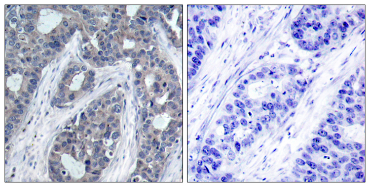 IRS1 Antibody - Immunohistochemistry analysis of paraffin-embedded human breast carcinoma, using IRS-1 (Phospho-Ser636) Antibody. The picture on the right is blocked with the phospho peptide.