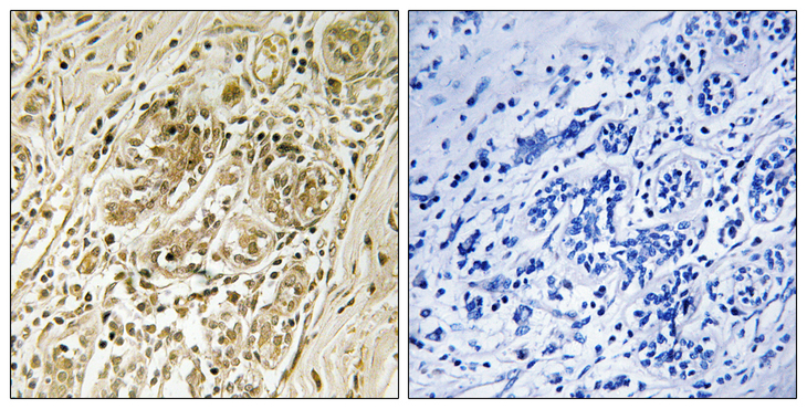 IRS1 Antibody - Immunohistochemistry analysis of paraffin-embedded human breast carcinoma, using IRS-1 (Phospho-Ser639) Antibody. The picture on the right is blocked with the phospho peptide.