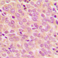 IRS1 Antibody - Immunohistochemical analysis of IRS1 (pS794) staining in human breast cancer formalin fixed paraffin embedded tissue section. The section was pre-treated using heat mediated antigen retrieval with sodium citrate buffer (pH 6.0). The section was then incubated with the antibody at room temperature and detected using an HRP conjugated compact polymer system. DAB was used as the chromogen. The section was then counterstained with hematoxylin and mounted with DPX.