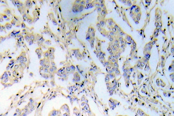 IRS1 Antibody - IHC of IRS-1 (P618) pAb in paraffin-embedded human breast carcinoma tissue.