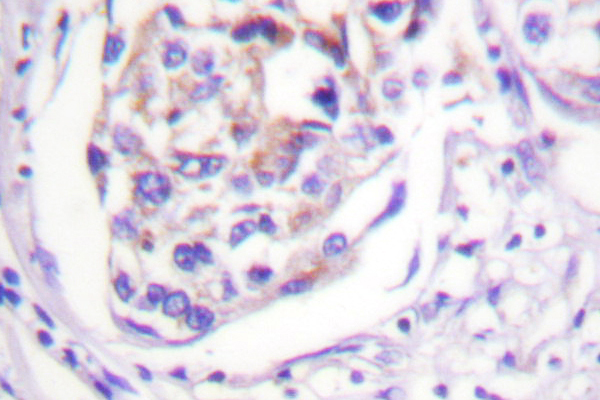 IRS1 Antibody - IHC of IRS-1 (V317) pAb in paraffin-embedded human breast carcinoma tissue.