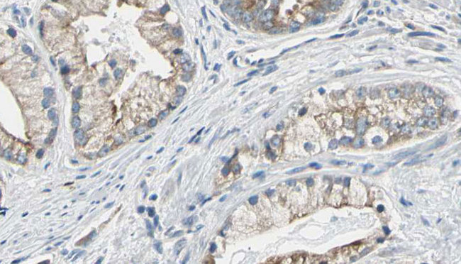 IRS2 / IRS-2 Antibody - 1:100 staining human prostate tissue by IHC-P. The sample was formaldehyde fixed and a heat mediated antigen retrieval step in citrate buffer was performed. The sample was then blocked and incubated with the antibody for 1.5 hours at 22°C. An HRP conjugated goat anti-rabbit antibody was used as the secondary.