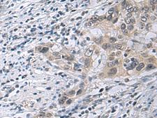 IRS4 Antibody - Immunohistochemistry of paraffin-embedded Human esophagus cancer tissue  using IRS4 Polyclonal Antibody at dilution of 1:45(×200)
