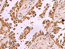 IRX1 Antibody - Immunohistochemistry of paraffin-embedded Human lung cancer tissue  using IRX1 Polyclonal Antibody at dilution of 1:35(×200)