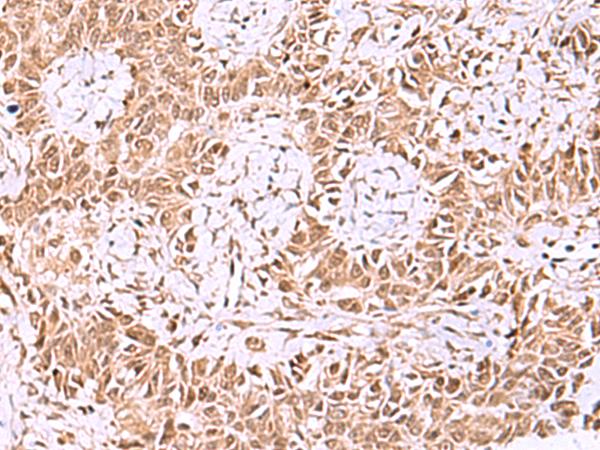 IRX1 Antibody - Immunohistochemistry of paraffin-embedded Human ovarian cancer tissue  using IRX1 Polyclonal Antibody at dilution of 1:35(×200)