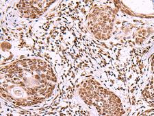 IRX1 Antibody - Immunohistochemistry of paraffin-embedded Human esophagus cancer tissue  using IRX1 Polyclonal Antibody at dilution of 1:40(×200)