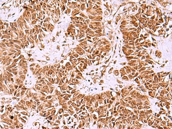 IRX1 Antibody - Immunohistochemistry of paraffin-embedded Human ovarian cancer tissue  using IRX1 Polyclonal Antibody at dilution of 1:40(×200)