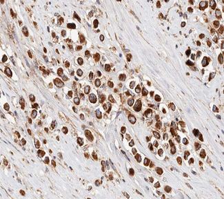 IRX2 Antibody - 1:100 staining human breast carcinoma tissue by IHC-P. The tissue was formaldehyde fixed and a heat mediated antigen retrieval step in citrate buffer was performed. The tissue was then blocked and incubated with the antibody for 1.5 hours at 22°C. An HRP conjugated goat anti-rabbit antibody was used as the secondary.
