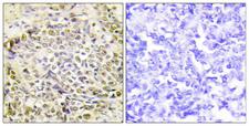 IRX2 Antibody - Peptide - + Immunohistochemistry analysis of paraffin-embedded human lung carcinoma tissue using IRX2 antibody.