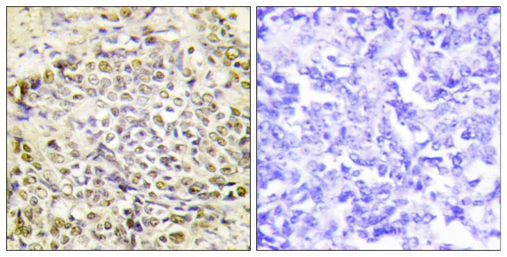 IRX2 Antibody - Peptide - + Immunohistochemistry analysis of paraffin-embedded human lung carcinoma tissue using IRX2 antibody.