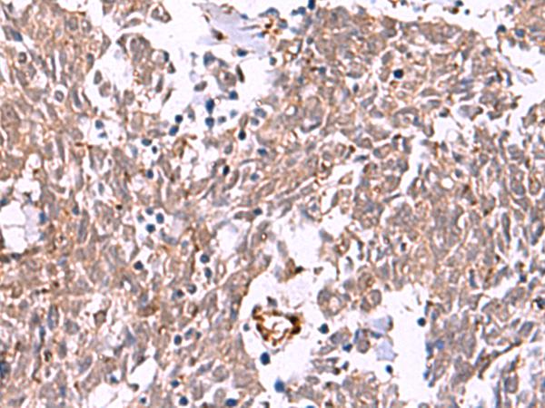 IRX2 Antibody - Immunohistochemistry of paraffin-embedded Human lung cancer tissue  using IRX2 Polyclonal Antibody at dilution of 1:45(×200)