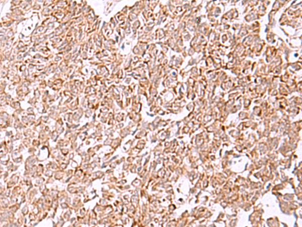 IRX2 Antibody - Immunohistochemistry of paraffin-embedded Human ovarian cancer tissue  using IRX2 Polyclonal Antibody at dilution of 1:45(×200)