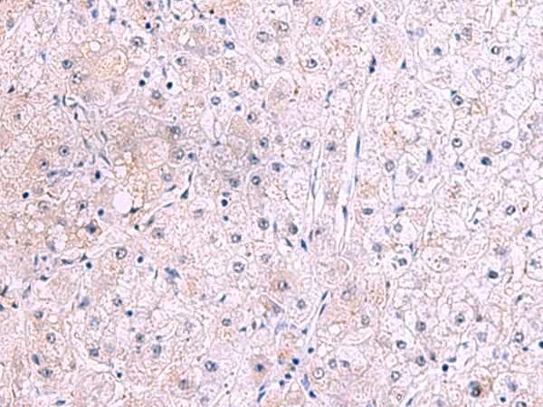 IRX2 Antibody - Immunohistochemistry of paraffin-embedded Human liver cancer tissue  using IRX2 Polyclonal Antibody at dilution of 1:45(×200)