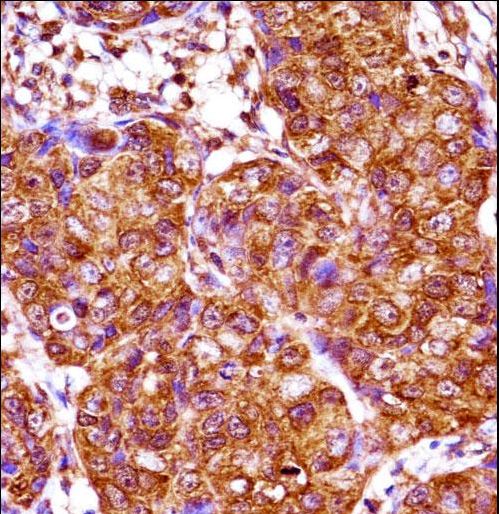 IRX3 Antibody - IRX3 Antibody immunohistochemistry of formalin-fixed and paraffin-embedded human breast carcinoma followed by peroxidase-conjugated secondary antibody and DAB staining.