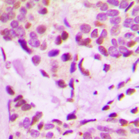 IRX3 Antibody - Immunohistochemical analysis of IRX3 staining in human breast cancer formalin fixed paraffin embedded tissue section. The section was pre-treated using heat mediated antigen retrieval with sodium citrate buffer (pH 6.0). The section was then incubated with the antibody at room temperature and detected using an HRP conjugated compact polymer system. DAB was used as the chromogen. The section was then counterstained with hematoxylin and mounted with DPX.