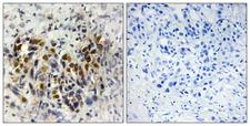 IRX3 Antibody - Peptide - + Immunohistochemistry analysis of paraffin-embedded human breast carcinoma tissue, using IRX3 antibody.
