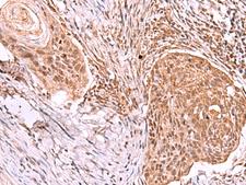 IRX4 Antibody - Immunohistochemistry of paraffin-embedded Human esophagus cancer tissue  using IRX4 Polyclonal Antibody at dilution of 1:40(×200)