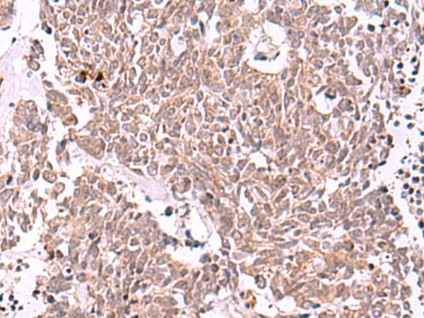 IRX4 Antibody - Immunohistochemistry of paraffin-embedded Human lung cancer tissue  using IRX4 Polyclonal Antibody at dilution of 1:40(×200)