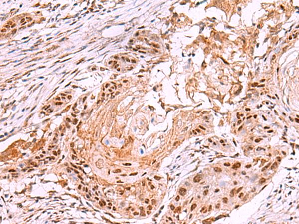 IRX4 Antibody - Immunohistochemistry of paraffin-embedded Human esophagus cancer tissue  using IRX4 Polyclonal Antibody at dilution of 1:35(×200)