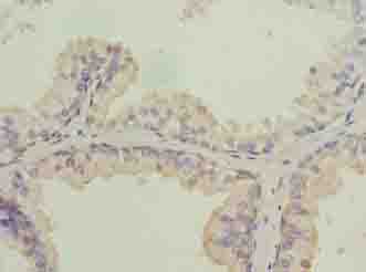 ISA2 / ISCA2 Antibody - Immunohistochemistry of paraffin-embedded human prostate cancer using antibody at dilution of 1:100.