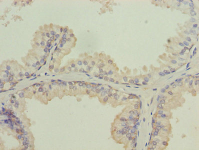 ISA2 / ISCA2 Antibody - Immunohistochemistry of paraffin-embedded human prostate cancer using ISCA2 Antibody at dilution of 1:100