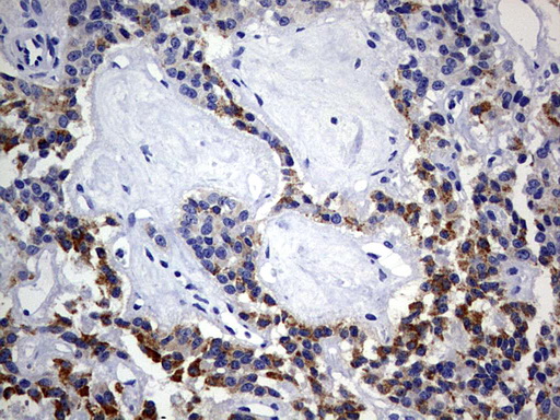 ISCU Antibody - IHC of paraffin-embedded Carcinoma of Human pancreas tissue using anti-ISCU mouse monoclonal antibody. (Heat-induced epitope retrieval by 10mM citric buffer, pH6.0, 120°C for 3min).