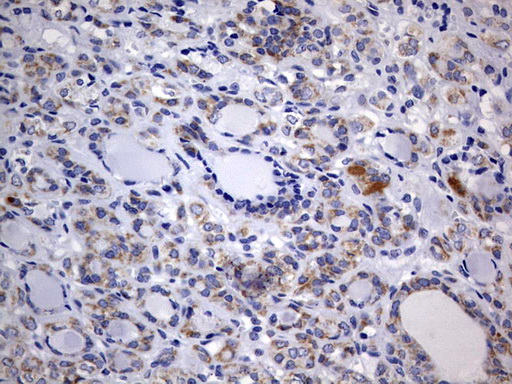 ISCU Antibody - IHC of paraffin-embedded Carcinoma of Human thyroid tissue using anti-ISCU mouse monoclonal antibody. (Heat-induced epitope retrieval by 10mM citric buffer, pH6.0, 120°C for 3min).