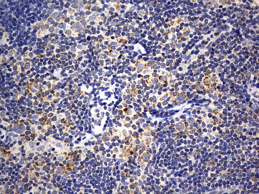 ISCU Antibody - IHC of paraffin-embedded Human lymphoma tissue using anti-ISCU mouse monoclonal antibody. (Heat-induced epitope retrieval by 10mM citric buffer, pH6.0, 120°C for 3min).