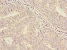 ISCU Antibody - Immunohistochemistry of paraffin-embedded human endometrial cancer at dilution 1:100
