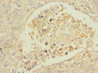 ISCU Antibody - Immunohistochemistry of paraffin-embedded human lung cancer at dilution 1:100