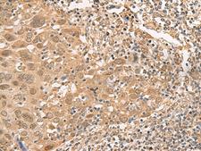 ISCU Antibody - Immunohistochemistry of paraffin-embedded Human cervical cancer tissue  using ISCU Polyclonal Antibody at dilution of 1:45(×200)